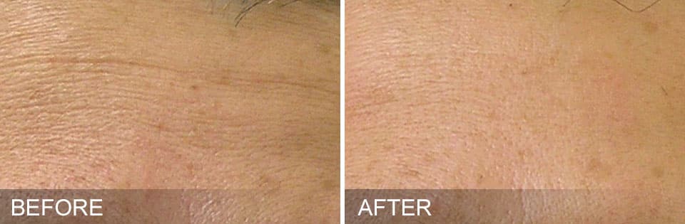 Before and After 1