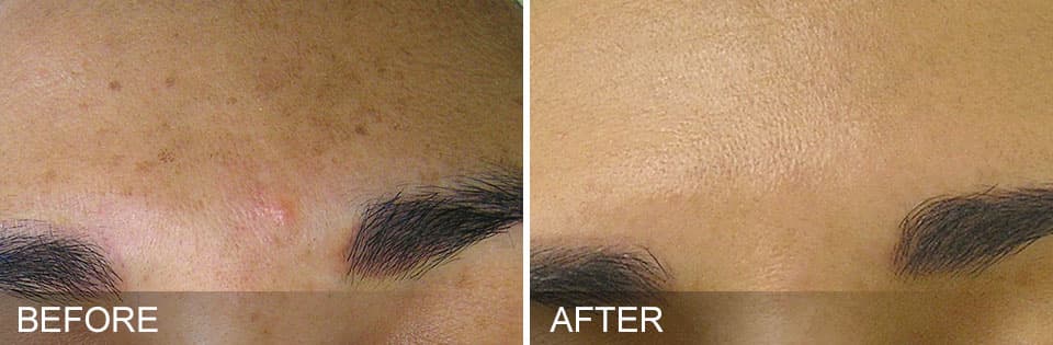 Before and After 1